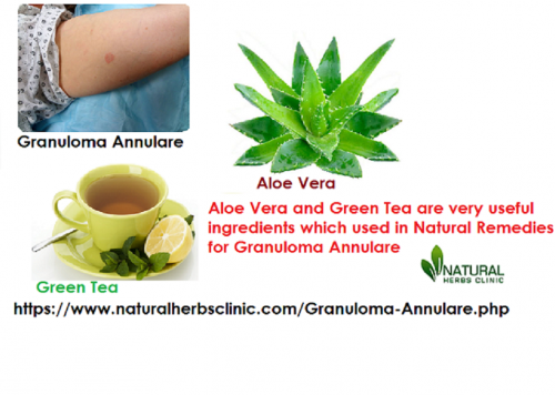 Aloe vera and green tea extract have antioxidant and healing properties for Natural Remedies for Granuloma Annulare which are very useful to recover from the disease... https://www.naturalherbsclinic.com/blog/natural-remedies-for-granuloma-annulare/