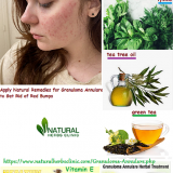 Apply-Natural-Remedies-for-Granuloma-Annulare-to-Get-Rid-of-Red-Bump