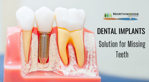Best-Dental-Implant-Clinic-for-Your-Treatment.png