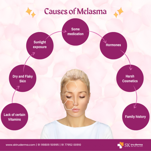 Causes-of-Melasma-Lady-Dermatologist-in-Sarjapur-Road.png