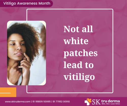 Fact-about-Vitiligo-Best-Skin-Specialist-in-Sarjapur-Road.png