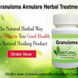 Granuloma-Annulare-Treatment60d5e47e2deeaa50