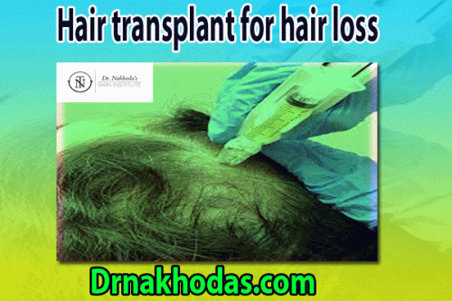 Hair transplant for hair loss