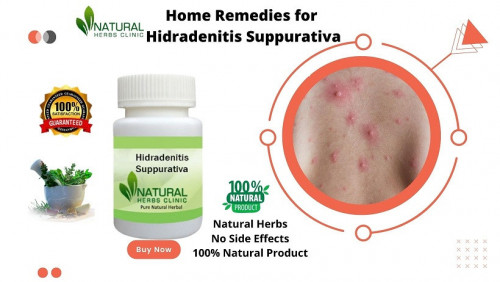 Home-Remedies-for-Hidradenitis-Suppurativa.jpg