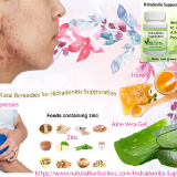 Home-Treatment-for-Skin-Rashes-Hidradenitis-Suppurativa