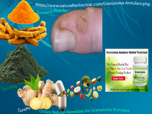 Spirulina is an exceptional immune system modulator that is usually used in Natural Remedies for Granuloma Annulare and many other skin-related conditions... https://www.dubaient.com/natural-remedies-for-granuloma-annulare/