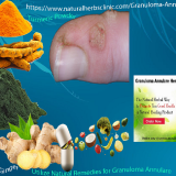 How-Might-Granuloma-Annulare-Be-Treated-with-Home-Remedies