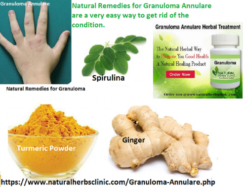 Ginger is well-known as one of the Natural Remedies for Granuloma Annulare. Consumption of ginger extract can reduce the Symptoms of Granuloma Annulare medical situation... https://blog.goo.ne.jp/naturalherbsclinic/e/86e836343f6bc59aefbb0ff134e22de0