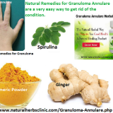 How-Might-Granuloma-Annulare-Be-Treated-with-Natural-Remedies