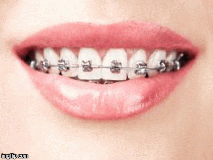 Invisalign treatment in Shadyside neighborhood in Pittsburgh will enable you to align your teeth by applying an almost invisible brace. Invisalign is a series of clear, custom fit removable mouth trays that put a measured amount of force to shift your teeth in a proper shape. Visit: https://www.shadysideorthodontics.com/how-it-works/ for more information.