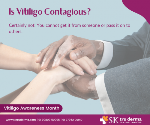 Is-Vitiligo-Contagious-Best-Skin-Specialist-in-Sarjapur-Road.png
