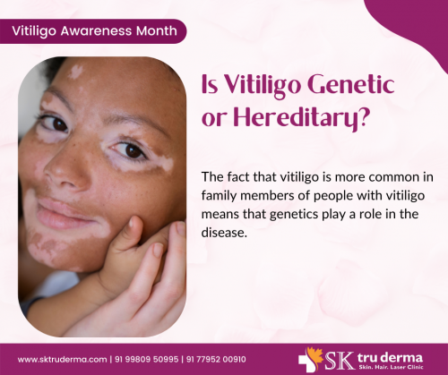 Is-Vitiligo-Genetic-or-Hereditary-Best-Skin-Specialist-in-Sarjapur-Road.png