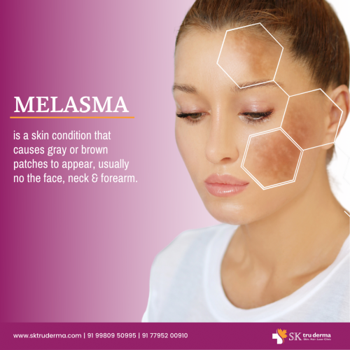 Melasma-Best-Skin-Care-Treatment-in-sarjapur-road.png