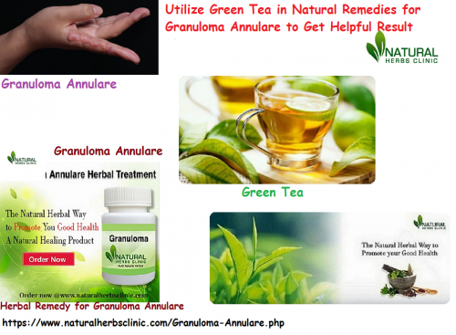 Green tea is one of the very cooperative drinks you can drink every day and it is used in Natural Remedies for Granuloma Annulare and other many diseases. It is a highly rich source of antioxidants in the shape of flavonoids named catechins... https://natural-herbs-clinic.myonline.store/a-62067871/our-products/4-natural-remedies-for-granuloma-annulare-to-stop-the-skin-disease/