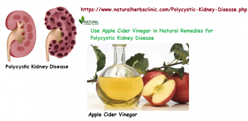 Apple cider vinegar has also antibacterial properties that are useful in Natural Remedies for Polycystic Kidney Disease. These antibacterial properties aid healing and even stop bacterial infections.... https://www.naturalherbsclinic.com/blog/natural-remedies-for-polycystic-kidney-disease/