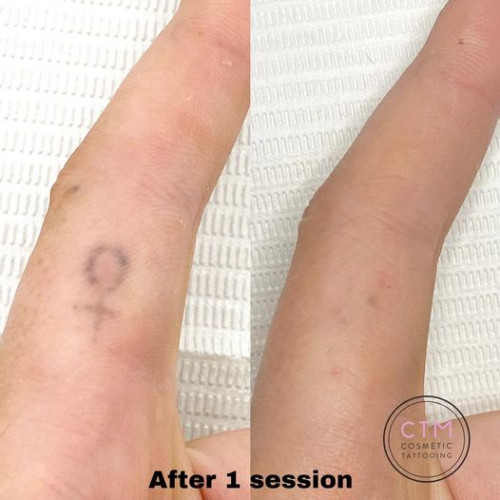 Picoway tattoo removal is a unique and amazing procedure for taatto removal. this  new technology removes unwanted tattoo pigment completely from anywhere on the body with minimal pain and minimum expense. For more information visit the website https://cosmetictattooingmelbourne.com.au/picoway-laser-tattoo-removal-2/

#lasertattooremoval #cosmetictattooing #CosmeticTattooingMelbourne