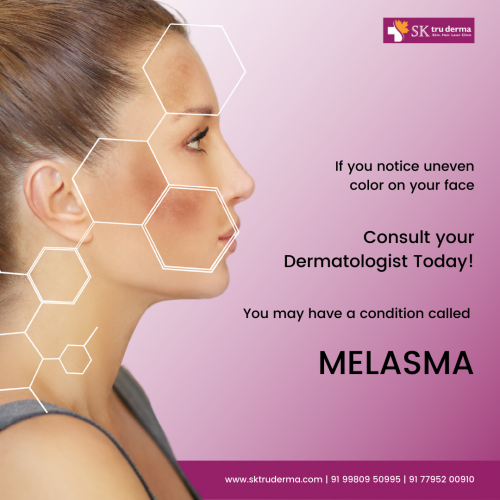 Suffering-from-Melasma-Best-Skin-Care-Treatment-in-sarjapur-road-at-Sk-truderma.png