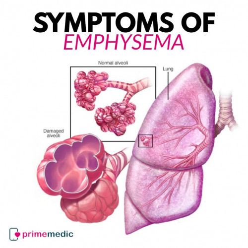 Symptoms-of-Emphysema.jpg