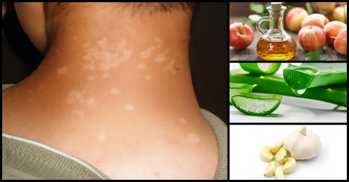 This is an extremely efficient home remedy that can aid in the all-Natural Treatment of Tinea Versicolor and other fungal infections. It contains medium-chain fatty acids, which function naturally as fungicides.
https://www.herbal-care-products.com/blog/tinea-versicolor-home-remedies-and-natural-treatment/