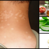 Tinea-versicolor-Home-Remedies-and-Natural-Treatment