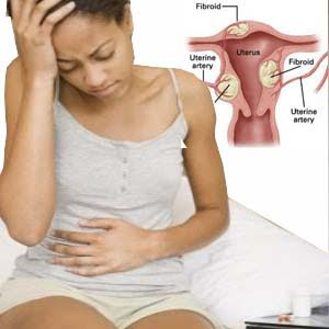 Treat-Fibroid-without-Surgery-2.png