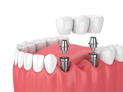 Types-of-dental-implants.jpg