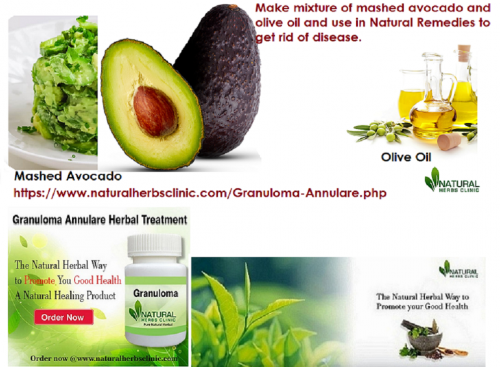 To deal with the skin condition avocado pulp can be used on the affected area of the body on a frequent basis. The use of a mixture of mashed avocado and olive oil can also assist in the Natural Remedies for Granuloma Annulare. Regular using up of avocado is also suggested.... http://myfishbook.fr/use-natural-remedies-for-granuloma-annulare-to-get-rid-of-it/