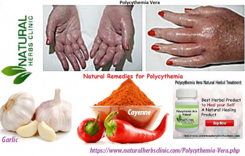 The garlic and cayenne are very useful herbal components used in Natural Remedies for Polycythemia Vera Herbal Treatment... https://natural-health-news.com/natural-remedies-for-polycythemia-vera/