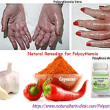 Use-Natural-Remedies-for-Polycythemia-Vera-to-Get-Rid-of-Completely