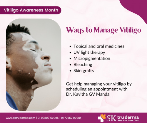 Ways-to-manage-Vitiligo-Best-Dermatologist-in-Sarjapur-Road.png
