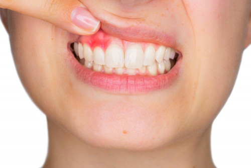 What-You-Need-to-Know-About-Gum-Disease.jpg