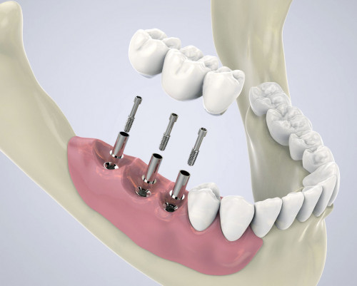 dental-implant.jpg