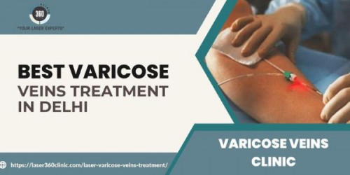 When you get ready to avail yourself of the best laser varicose veins treatment in Delhi, you must prefer to reach Laser360Clinic which guarantees the best treatment.
https://laser360clinic.com/looking-for-top-treatment-about-varicose-veins-5-things-you-cannot-deny/