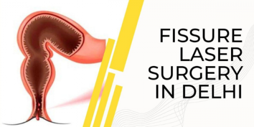 Earlier, treatment of anal fissures was quite frightful. But laser treatment for fissures has transformed the scenario of the medical industry.
https://laser360clinic.com/something-you-should-know-about-the-food-to-avoid-in-fissures/