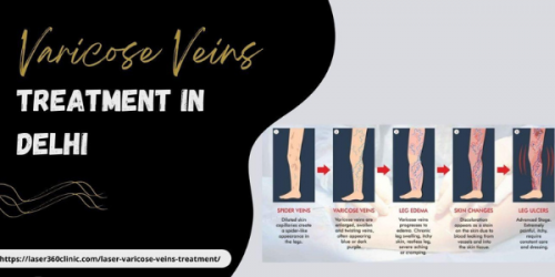 Are you worried about the varicose veins laser treatment cost in Delhi? If so, then Laser360Clinic sets you free from this worry as well.
https://laser360clinic.com/benefits-of-availing-top-varicose-veins-treatment-at-laser360clinic/