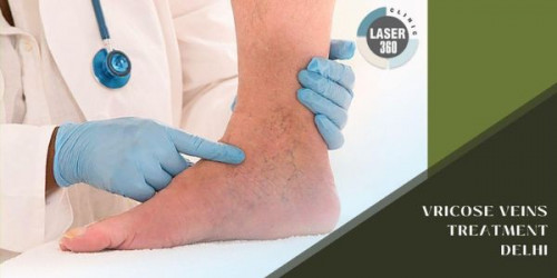 If you should always trust Laser360Clinic for the best varicose veins laser treatment cost. You can never avoid talking to the experts at the clinic.
https://laser360clinic.com/strength-of-the-best-clinic-for-varicose-veins-treatment/
